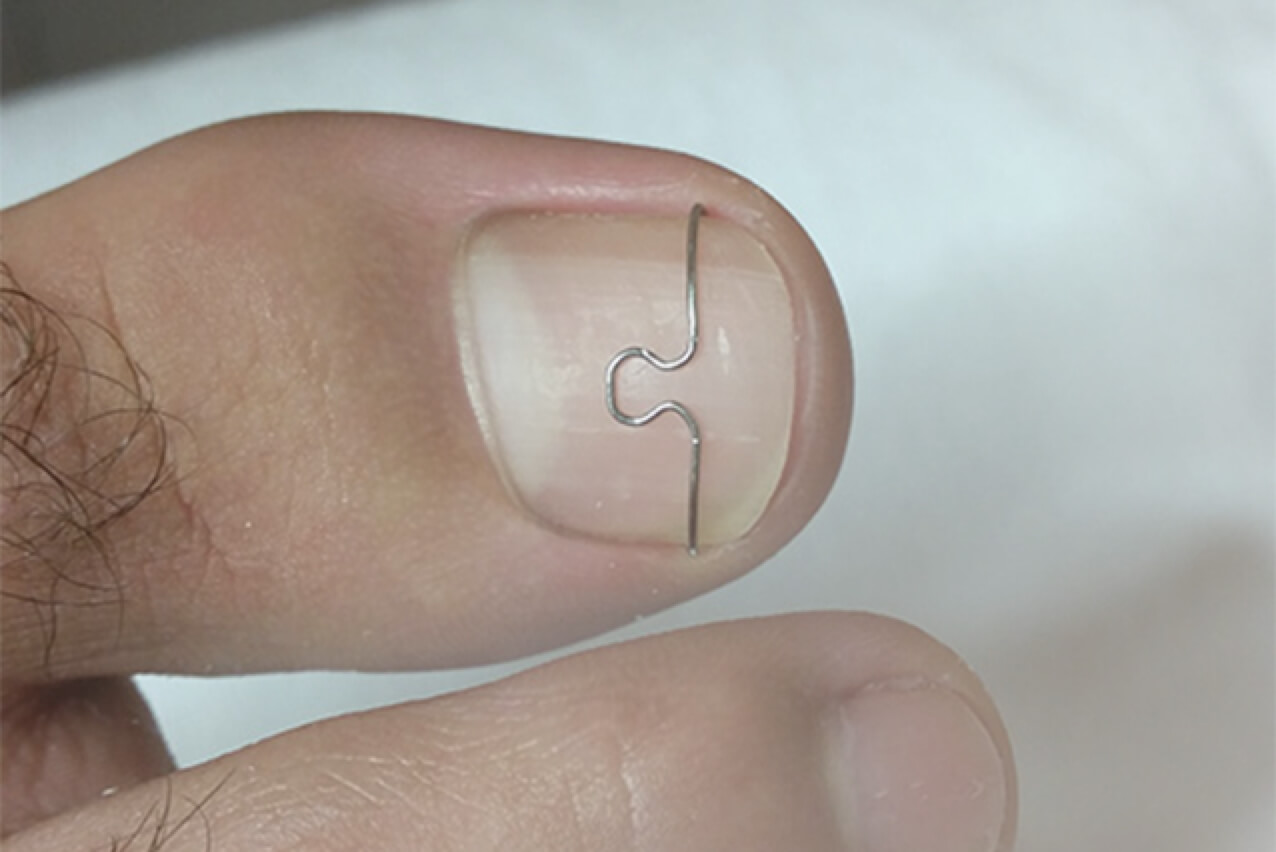 podoberlin-nagelkorrekturspangen-bei-eingewachsenen-nageln